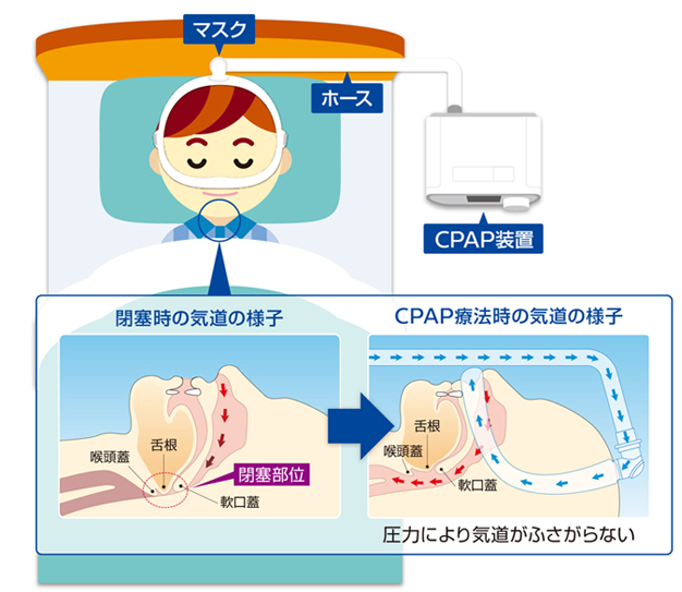 CPAP療法